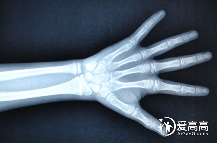 儿童青少年手腕部骨发育与x线骨龄测评