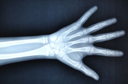 儿童青少年手腕部骨发育与X线骨龄测评